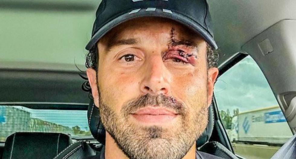 Fabio Grosso after suffering facial assault: 