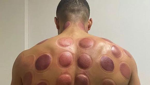 La espalda del delantero Arnaut Danjuma tras utilizar la ventosaterapia como método de recuperación. (Foto: Instagram)