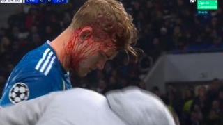 ¡Terrible! El sangrado de Matthijs de Ligt luego que le pisen el cráneo en el Juventus vs. Lyon por Champions League