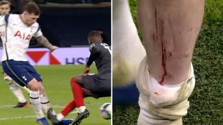 De terror: la impactante lesión de jugador de Tottenham tras terrible entrada en la Copa de la Liga [VIDEO]