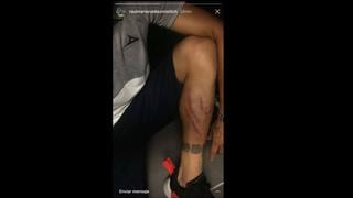 ¿No era amistoso? las duras imágenes de la pierna de Ruidiaz luego del partido ante León