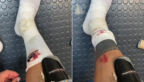 Carlos Salcedo y la herida en la pierna luego del duelo ante Santos. (Twitter de Carlos Salcedo)