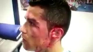 Se revelaron fuertes imágenes del corte que sufrió Cristiano Ronaldo ante Deportivo [VIDEO]
