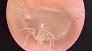 El video viral de la araña encontrada en el interior del oído de una mujer