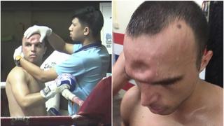Peleador de muay thai que recibió brutal codazo quedó así tras someterse a una cirugía [VIDEO]