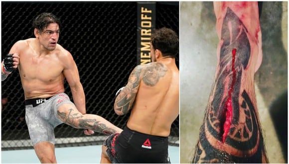 Así quedó la canilla del 'Moggly’ Benítez luego de su pelea en el UFC Fight Night de Florida. (Getty Images/Instagram)