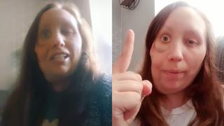 Sarah Harris, la mujer que perdió un ojo por una rara enfermedad y hoy es estrella de TikTok