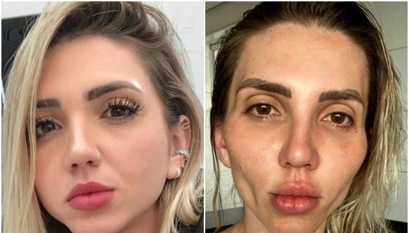 Una influencer brasileña se arrepiente de cirugía que se hizo en el rostro. (Foto: @eusoufrozza / Instagram)