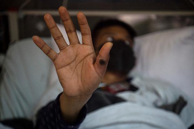 Paciente con el virus mpox (Foto: AFP)