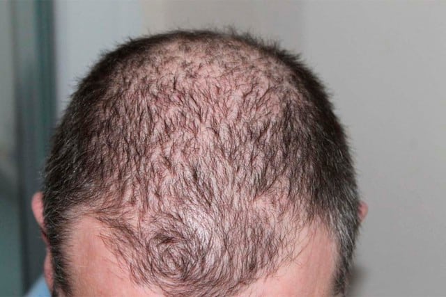 Edward Willett contrajo severas enfermedades luego de someterse a un supuesto trasplante de cabello. | Foto: Pexels/Referencial. (Desliza hacia la izquierda para ver más imágenes).