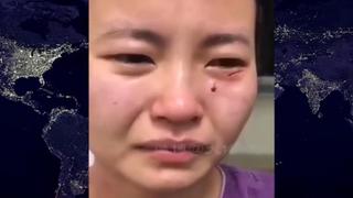 China: enfermera es brutalmente mordida en el rostro por hombre con coronavirus 
