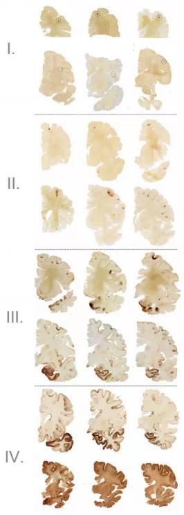Estas son las cuatro etapas de la encefalopatía traumática crónica, siendo la IV la más severa. El daño al cerebro es preocupante. (Brain: a journal of neurology)