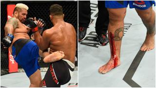 El terrible corte en la pierna que sufrió Mark Hunt ante Alistair Overeem en el UFC 209