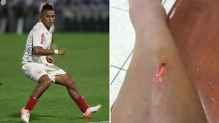 Universitario de Deportes: así quedó la pierna de Diego Chávez tras empate ante Aurich