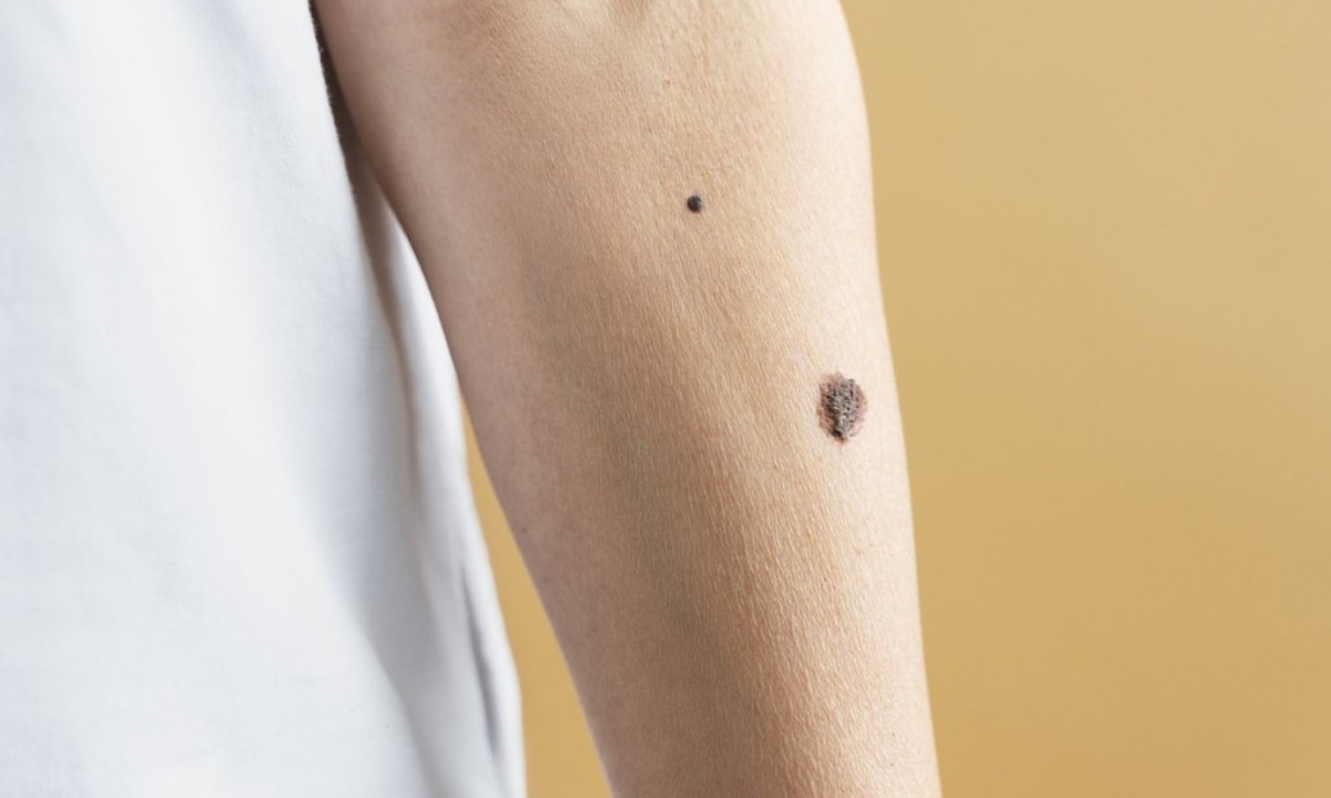 Conoce cuáles son las causas del cáncer de piel. (Foto: Agencias)