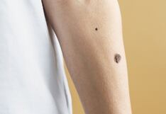Cáncer de piel: recomendaciones para prevenir, cómo detectar a tiempo y síntomas