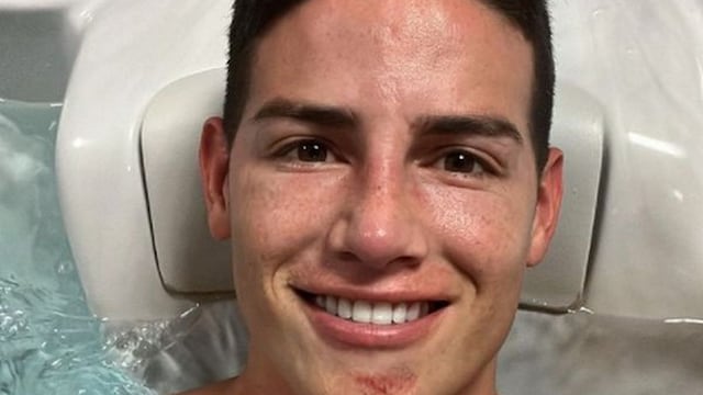 Notoriamente golpeado: James mostró cómo quedó su rostro tras recibir peligrosa falta