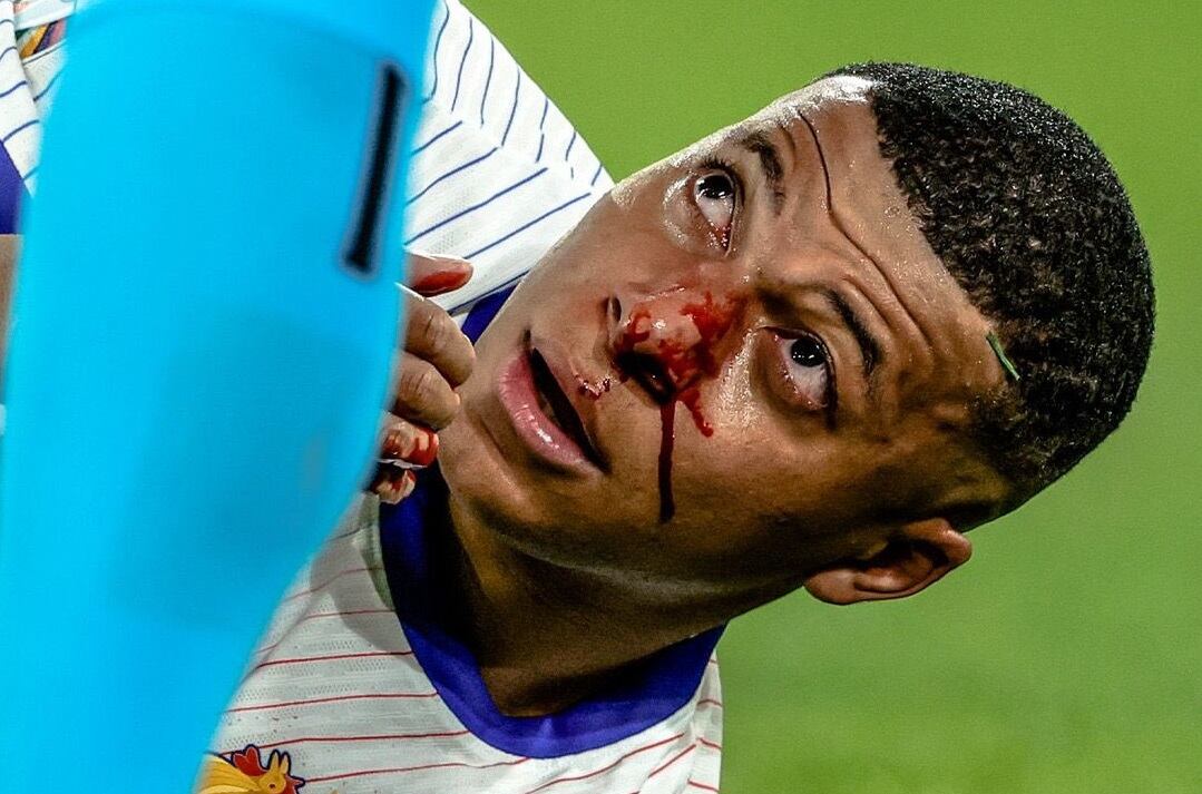 Kylian Mbappé terminó con la nariz fracturada, tras duro choque con Kevin Danso durante el Francia vs Austria por Eurocopa.