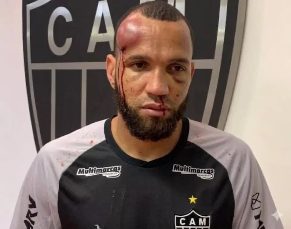 Así terminó el golero Everson, protagonista de la pelea. (Foto: Atlético Mineiro)