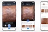 Cómo usar Google Lens para identificar mancha en la piel, desde lunares hasta afecciones graves
