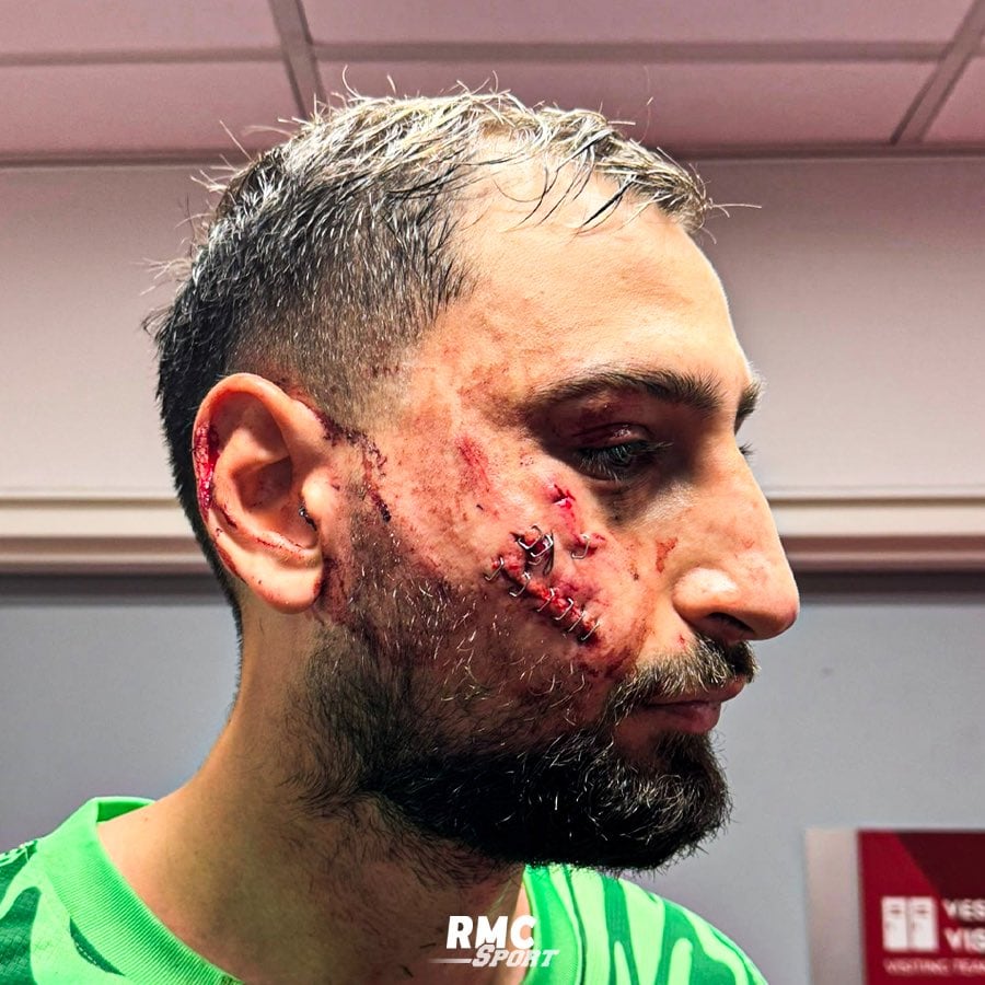 Así quedó el rostro de Gianluigi Donnarumma. (Foto: Arthur Perrot).