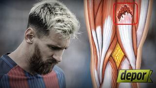 Lionel Messi: ¿en qué consiste la lesión que lo hará perderse duelo ante Perú?
