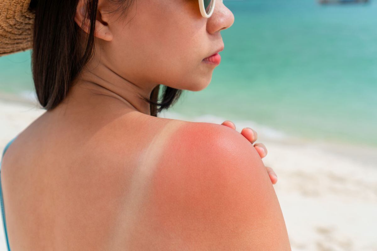 Según la dermatóloga Sara Moghaddam, tener cinco o más quemaduras graves entre los 15 y 20 años incrementa el riesgo de melanoma en un 80%. (Foto referencial: iStock)