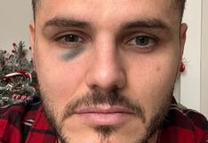 No más ojo morado de Mauro Icardi: así lo tapó Wanda Nara con maquillaje
