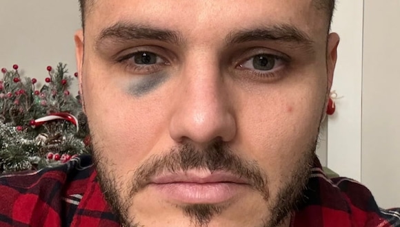 Wanda Nara tapó el ojo morado de Mauro Icardi con maquillaje. (Video: Wanda Nara)