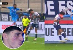 Así quedó el rostro de Franco Zanelatto tras patada de Alexi Gómez