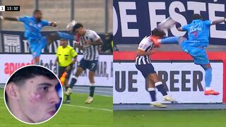 Así quedó el rostro de Franco Zanelatto tras patada de Alexi Gómez