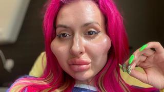 Viral: descubre a la modelo ucraniana que abusa del relleno facial