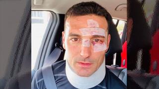 Scaloni mostró cómo le quedó la cara tras ser atropellado en Mallorca y dejó un mensaje de tranquilidad